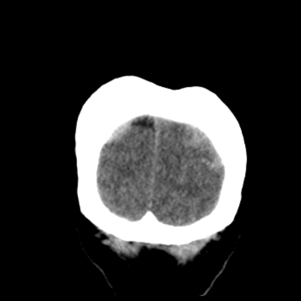 Bilateral subdural hemorrhages (Radiopaedia 26588-26732 Coronal non-contrast 56).jpg