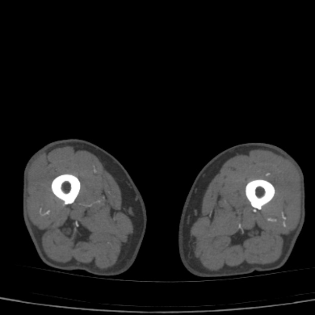 Bilateral superficial femoral arterial occlusion (Radiopaedia 25682-25857 A 45).jpg