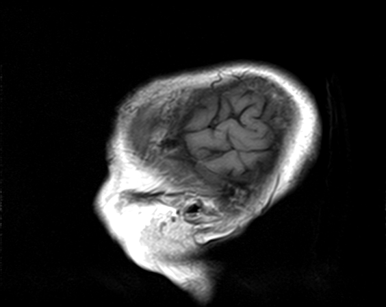 File:Bilateral thalamic glioma (Radiopaedia 65852-75009 Sagittal T1 1).jpg
