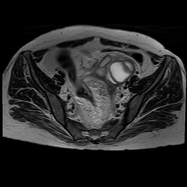 Bilateral tubo-ovarian abscesses (Radiopaedia 58635-65829 Axial T2 16).jpg