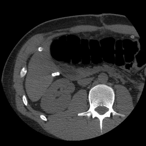 File:Bile leak from liver traumatic laceration (Radiopaedia 63463-72077 Axial Biliscopin 65).jpg