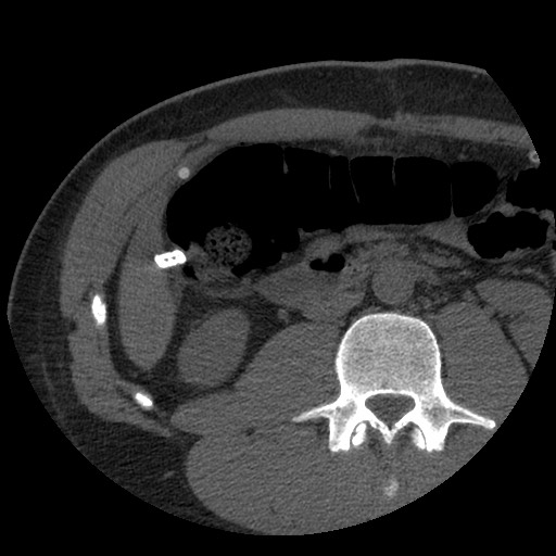 Bile leak from liver traumatic laceration (Radiopaedia 63463-72077 Axial Biliscopin 76).jpg