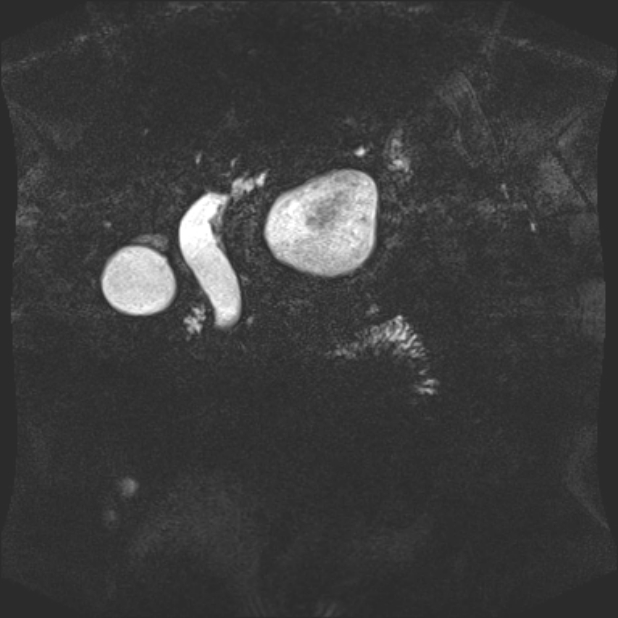 Biliary pancreatitis (Radiopaedia 72289-82824 Coronal 3D T2 36).jpg