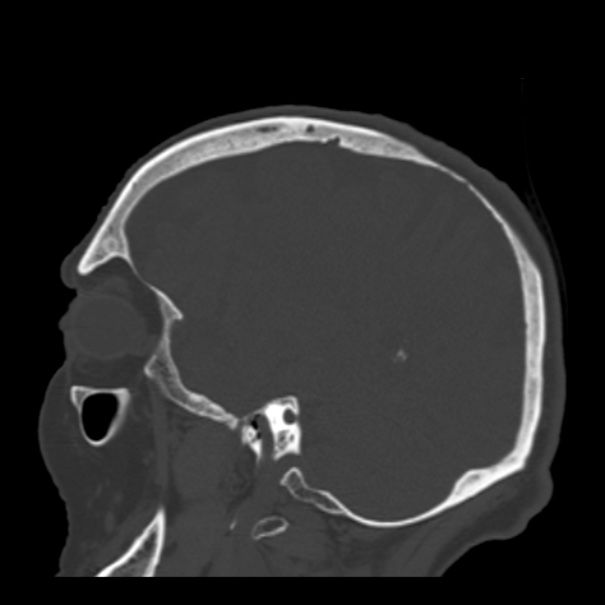 Biparietal osteodystrophy (Radiopaedia 46109-50463 Sagittal bone window 33).jpg
