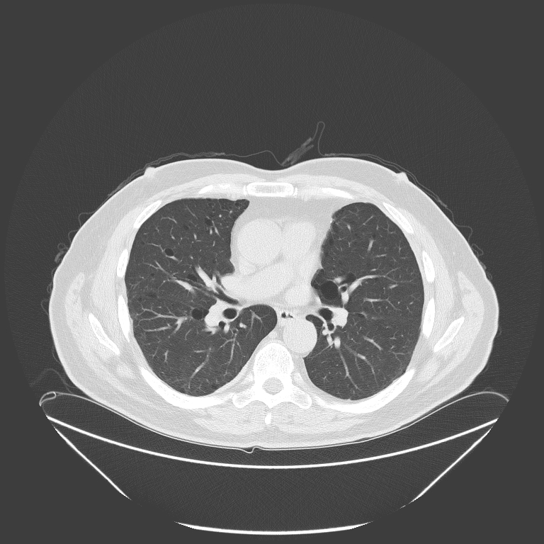 Birt-Hogg-Dubé syndrome (Radiopaedia 52578-58491 Axial lung window 31).jpg