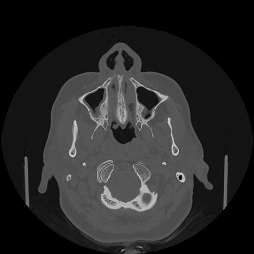 File:Bisphosphonate-related osteonecrosis of the jaw (Radiopaedia 71324-81642 Axial bone window 125).jpg
