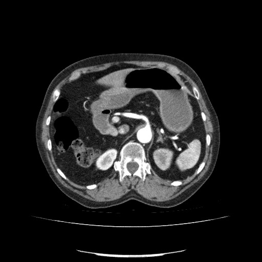 File:Bladder tumor detected on trauma CT (Radiopaedia 51809-57609 A 91).jpg