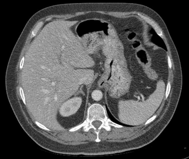 File:Bleeding duodenal ulcer and adenomyomatosis of gallbladder (Radiopaedia 61834-69861 A 24).jpg