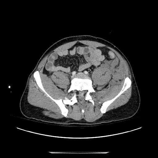Blunt abdominal trauma with solid organ and musculoskelatal injury with active extravasation (Radiopaedia 68364-77895 A 110).jpg