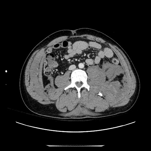 Blunt abdominal trauma with solid organ and musculoskelatal injury with active extravasation (Radiopaedia 68364-77895 A 84).jpg