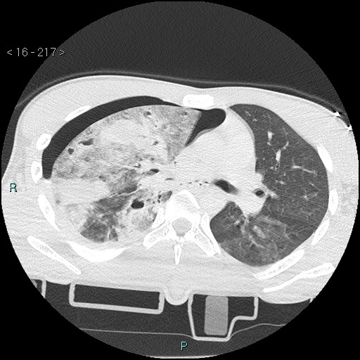 Blunt chest trauma (Swiss cheese sign) (Radiopaedia 38519-40618 Axial lung window 30).jpg