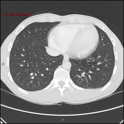 File:Blunt chest trauma - pulmonary interstitial emphysema and pneumomediastinum (Radiopaedia 20666-20552 Axial lung window 45).jpg