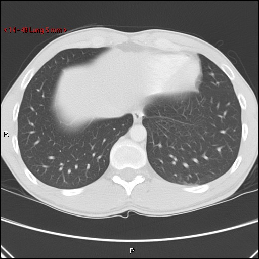 File:Blunt chest trauma - pulmonary interstitial emphysema and pneumomediastinum (Radiopaedia 20666-20552 Axial lung window 49).jpg