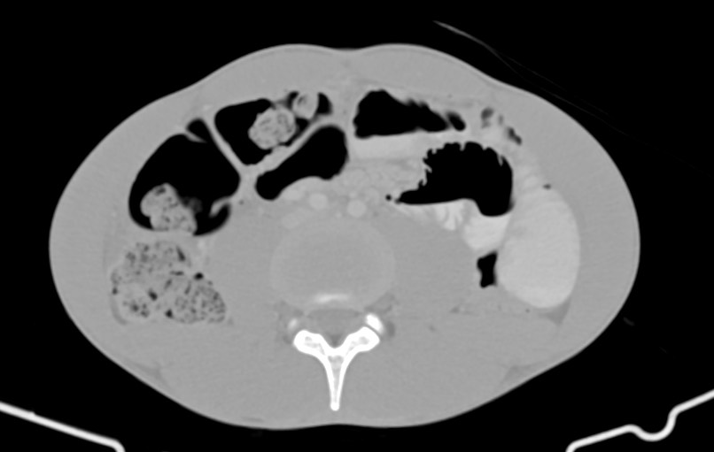 Blunt injury to the small bowel (Radiopaedia 74953-85987 Axial Wide 54).jpg