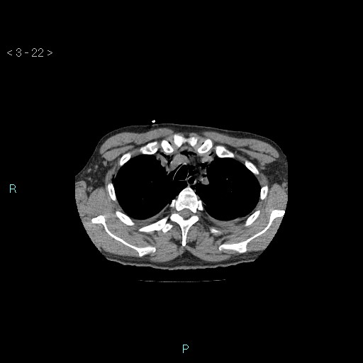 File:Boerhaave syndrome (Radiopaedia 27683-27897 Axial non-contrast 22).jpg