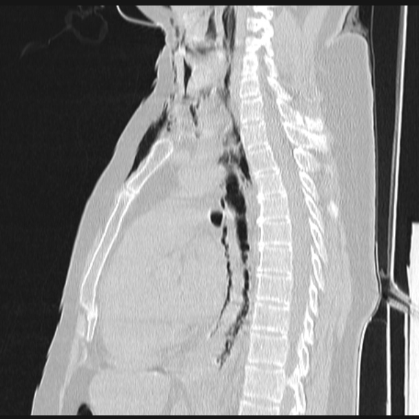 Boerhaave syndrome (Radiopaedia 45644-49799 Sagittal lung window 43).jpg