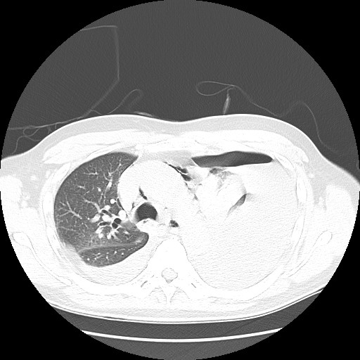 Boerhaave syndrome (Radiopaedia 59796-67310 Axial lung window 24).jpg