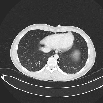 File:Boerhaave syndrome with mediastinal, axillary, neck and epidural free gas (Radiopaedia 41297-44115 Axial lung window 68).jpg