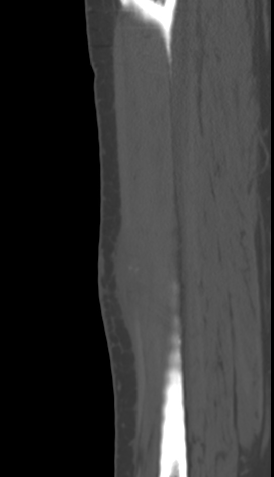 Bone metastasis - tibia (Radiopaedia 57665-64609 Sagittal bone window 118).jpg