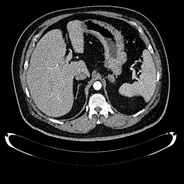 Bosniak renal cyst - type IV (Radiopaedia 24244-24518 B 72).jpg