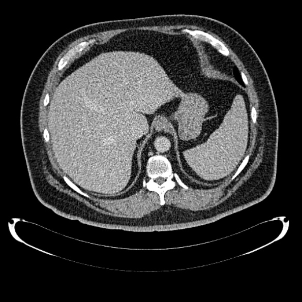 Bosniak renal cyst - type IV (Radiopaedia 24244-24518 C 46).jpg