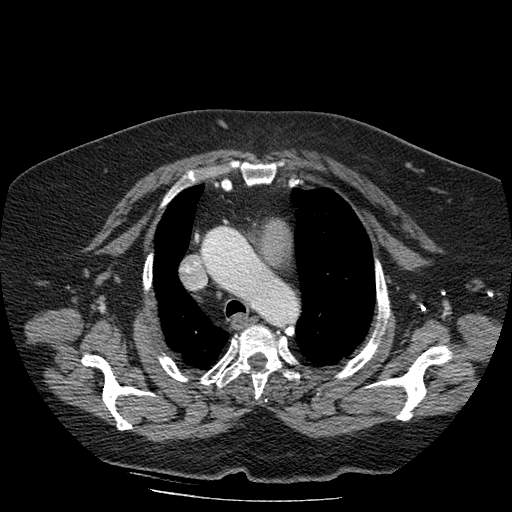 Bovine aortic arch - right internal mammary vein drains into the superior vena cava (Radiopaedia 63296-71875 A 37).jpg