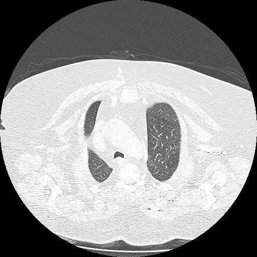 Bovine aortic arch - right internal mammary vein drains into the superior vena cava (Radiopaedia 63296-71875 Axial lung window 31).jpg