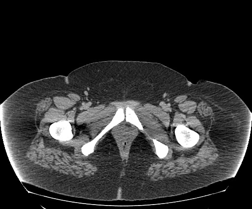 Bowel and splenic infarcts in acute lymphocytic leukemia (Radiopaedia 61055-68913 A 129).jpg