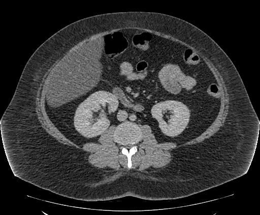 Bowel and splenic infarcts in acute lymphocytic leukemia (Radiopaedia 61055-68913 A 67).jpg