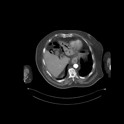 File:Bowel ischemia secondary to SMA occlusion with extensive portomesenteric venous gas (Radiopaedia 54656-60871 A 66).jpg
