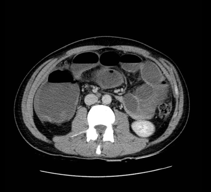 Bowel obstruction from colon carcinoma (Radiopaedia 22995-23028 A 41).jpg