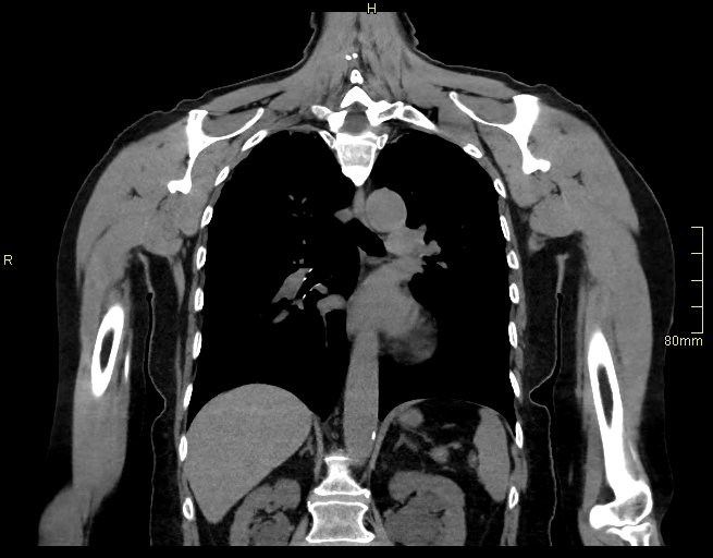 Brachial artery foreign body (Radiopaedia 54583-60820 Coronal non-contrast 35).jpg