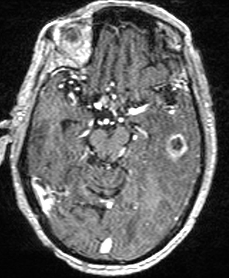 Brain abscess with dual rim sign (Radiopaedia 87566-103938 Axial T1 C+ 67).jpg