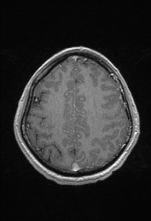 Brain abscess with ventriculitis (Radiopaedia 85703-101495 Axial T1 C+ 132).jpg