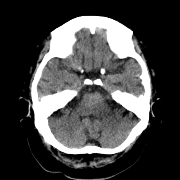 Brain cortical laminar necrosis (Radiopaedia 25822-25971 Axial non-contrast 11).jpg