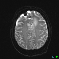 File:Brain death on MRI and CT angiography (Radiopaedia 42560-45689 Axial ADC 24).jpg