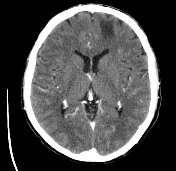 File:Brain metastases from lung cancer (Radiopaedia 24480-24781 Axial C+ delayed 31).jpg