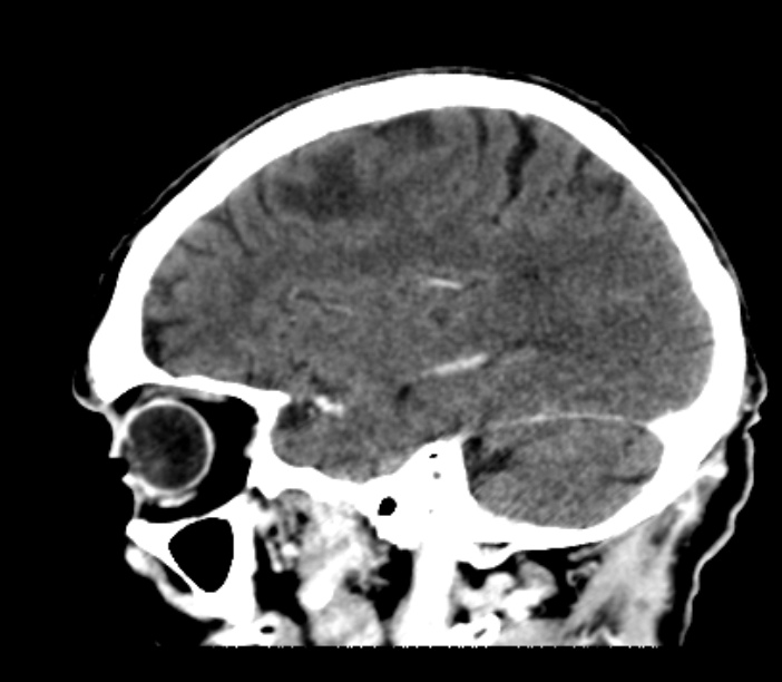 Brain metastases from lung cancer (Radiopaedia 27849-28092 Sagittal C+ delayed 44).jpg