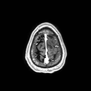 Brain metastases from lung cancer (Radiopaedia 83839-99028 Axial T1 C+ 64).jpg
