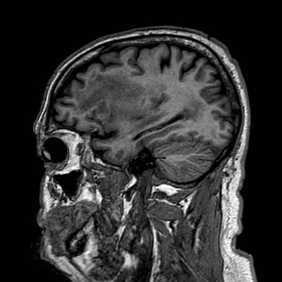 Brain metastases from lung cancer (Radiopaedia 83839-99028 Sagittal T1 33).jpg