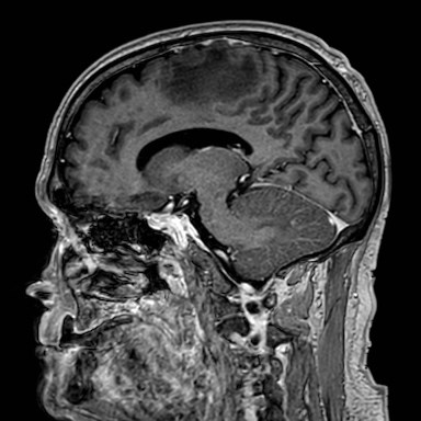 Brain metastases from lung cancer (Radiopaedia 83839-99028 Sagittal T1 C+ 37).jpg
