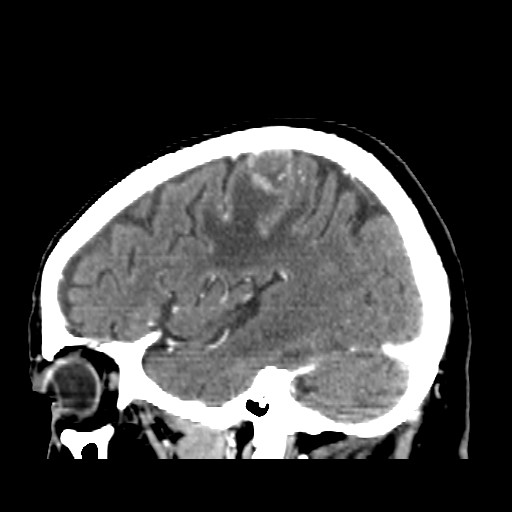 Brain metastasis (Radiopaedia 42617-45760 D 43).jpg