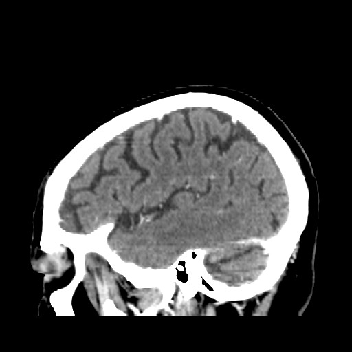 Brain metastasis (Radiopaedia 42617-45760 D 8).jpg