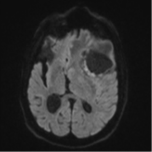 Brain metastasis (lung cancer) (Radiopaedia 48289-53179 Axial DWI 42).png