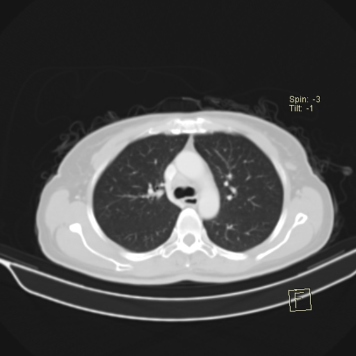 File:Brain metastasis as initial presentation of non-small cell lung cancer (Radiopaedia 65122-74127 Axial lung window 17).jpg