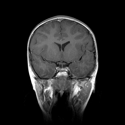 File:Brainstem ganglioglioma (Radiopaedia 10763-11224 Coronal T1 C+ 12).jpg