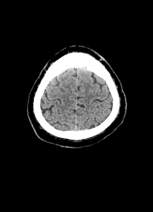 Brainstem hemorrhage (Radiopaedia 81294-94976 Axial non-contrast 12).jpg