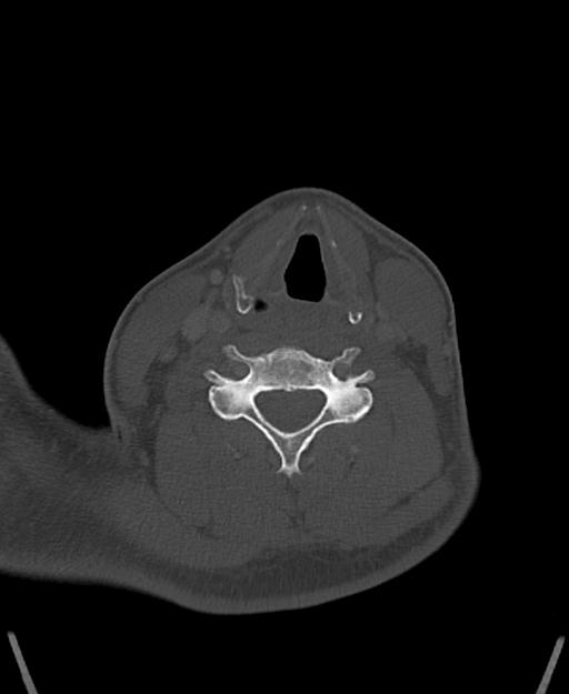 Branchial cleft cyst (Radiopaedia 31167-31875 Axial bone window 46).jpg