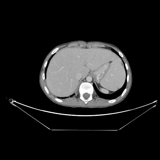 Bronchial carcinoid tumor (Radiopaedia 57187-64090 A 69).jpg
