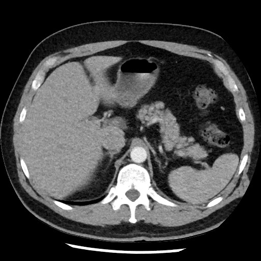 Bronchial carcinoid tumor (Radiopaedia 67377-76764 A 61).jpg